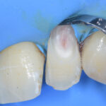 Riassorbimento cervicale esterno Riassorbimento cervicale esterno