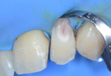 Riassorbimento cervicale esterno Riassorbimento cervicale esterno