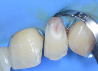 Riassorbimento cervicale esterno Riassorbimento cervicale esterno