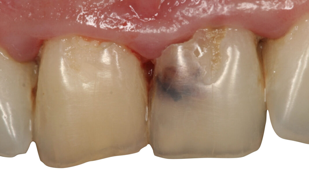 5 riassorbimenti radicolari