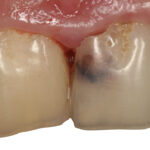 Riassorbimenti radicolari: come trattarli in modo efficace riassorbimenti radicolari