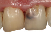 Riassorbimenti radicolari: come trattarli in modo efficace riassorbimenti radicolari