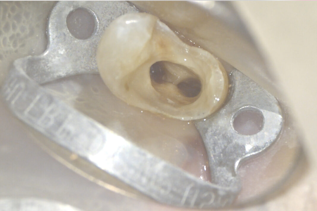 5_Fibra Ritrattamento canalare