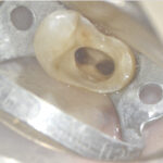 Ritrattamento canalare. Rimozione di 2 perni in fibra con tecnica ultrasonica Ritrattamento canalare