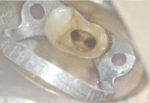 Ritrattamento canalare. Rimozione di 2 perni in fibra con tecnica ultrasonica Ritrattamento canalare