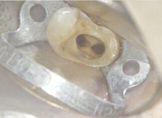 Ritrattamento canalare. Rimozione di 2 perni in fibra con tecnica ultrasonica Ritrattamento canalare