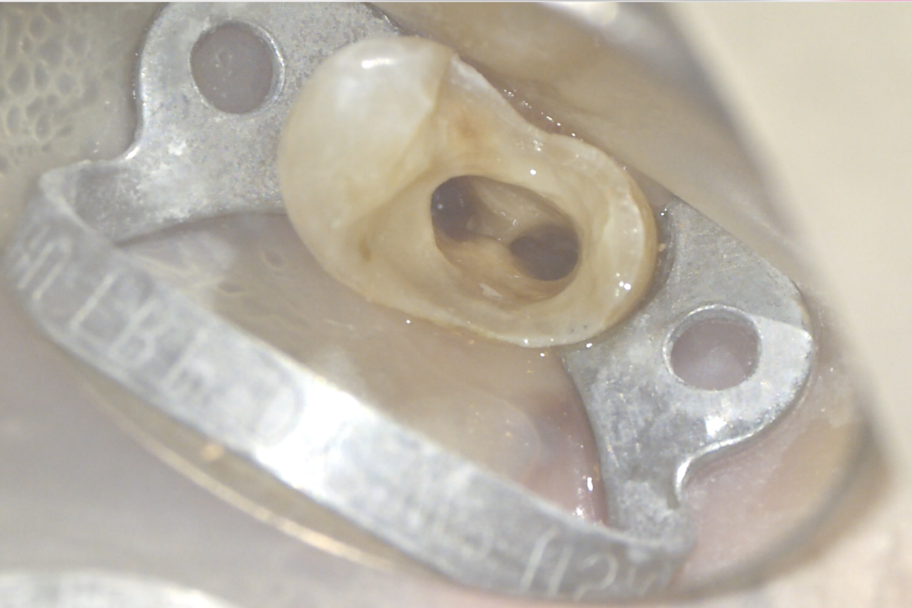 Ritrattamento canalare