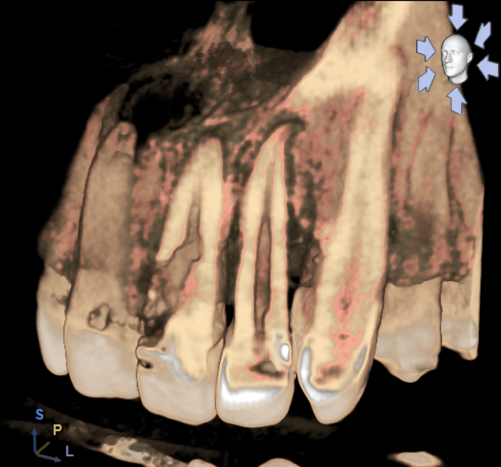 Riassorbimenti radicolari