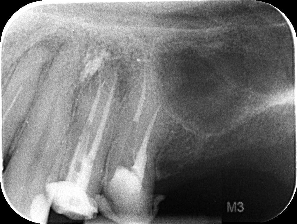 Ritrattamento canalare