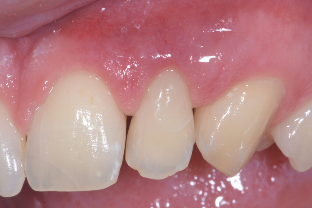 Riassorbimento cervicale esterno