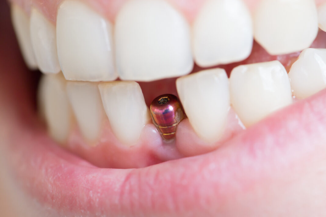 single tooth implant carie interprossimale e impianti