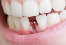 Carie interprossimale adiacente agli impianti, come evitarla carie interprossimale e impianti