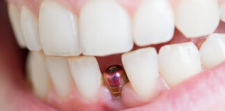 Carie interprossimale adiacente agli impianti, come evitarla carie interprossimale e impianti