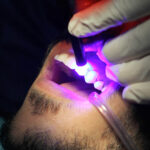 Fotopolimerizzazione e microleakage: cosa c’è di nuovo da sapere Fotopolimerizzazione