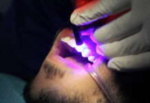 Fotopolimerizzazione e microleakage: cosa c’è di nuovo da sapere Fotopolimerizzazione