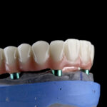 Protesi fisse su impianti: migliorano la qualità della vita e riducono l’ansia protesi impianti