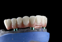 Protesi fisse su impianti: migliorano la qualità della vita e riducono l’ansia protesi impianti