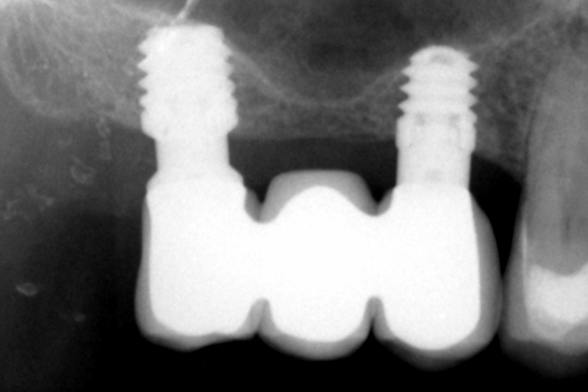 Carico immediato impianti ultra-corti