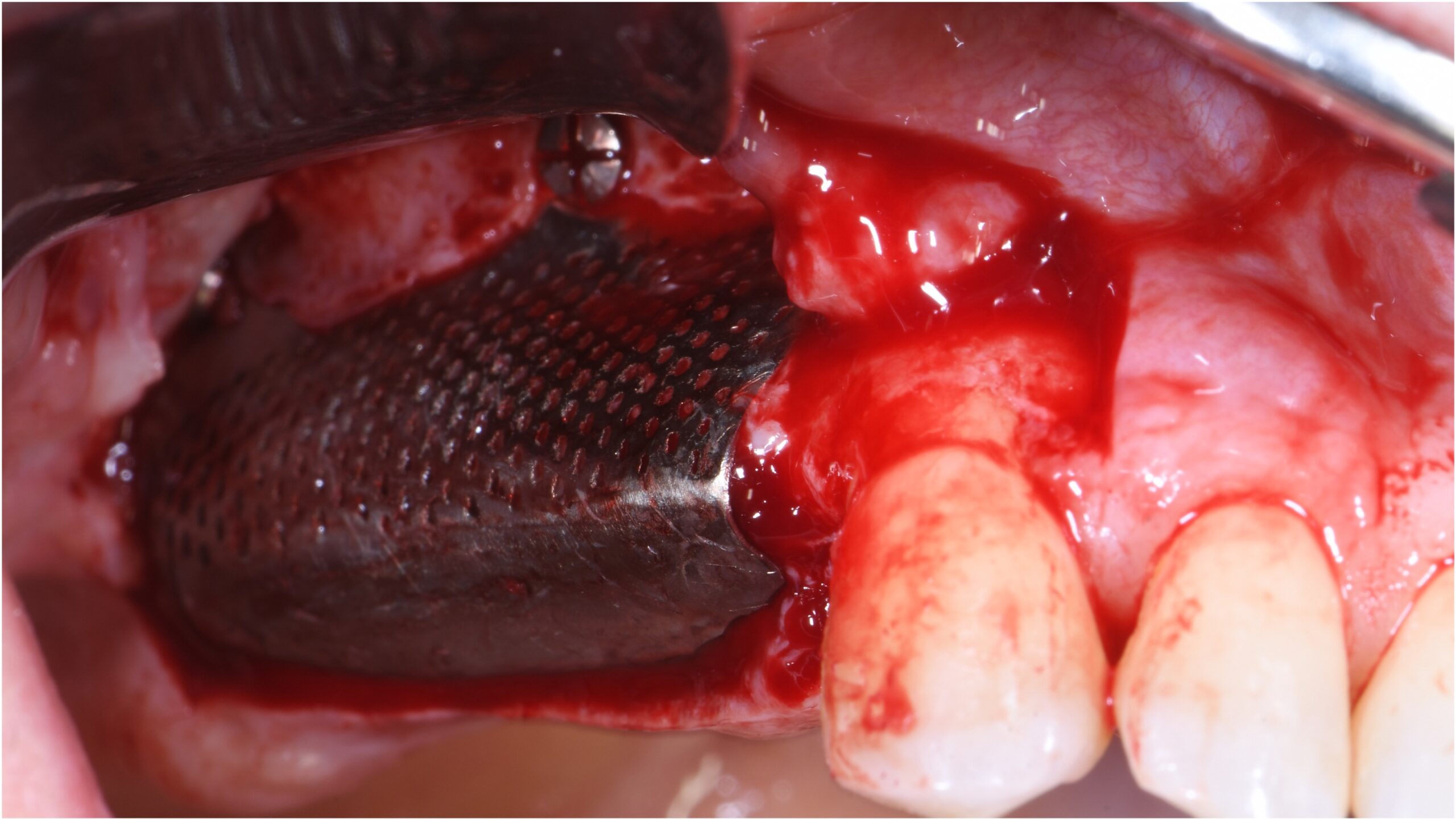 mesh in titanio 