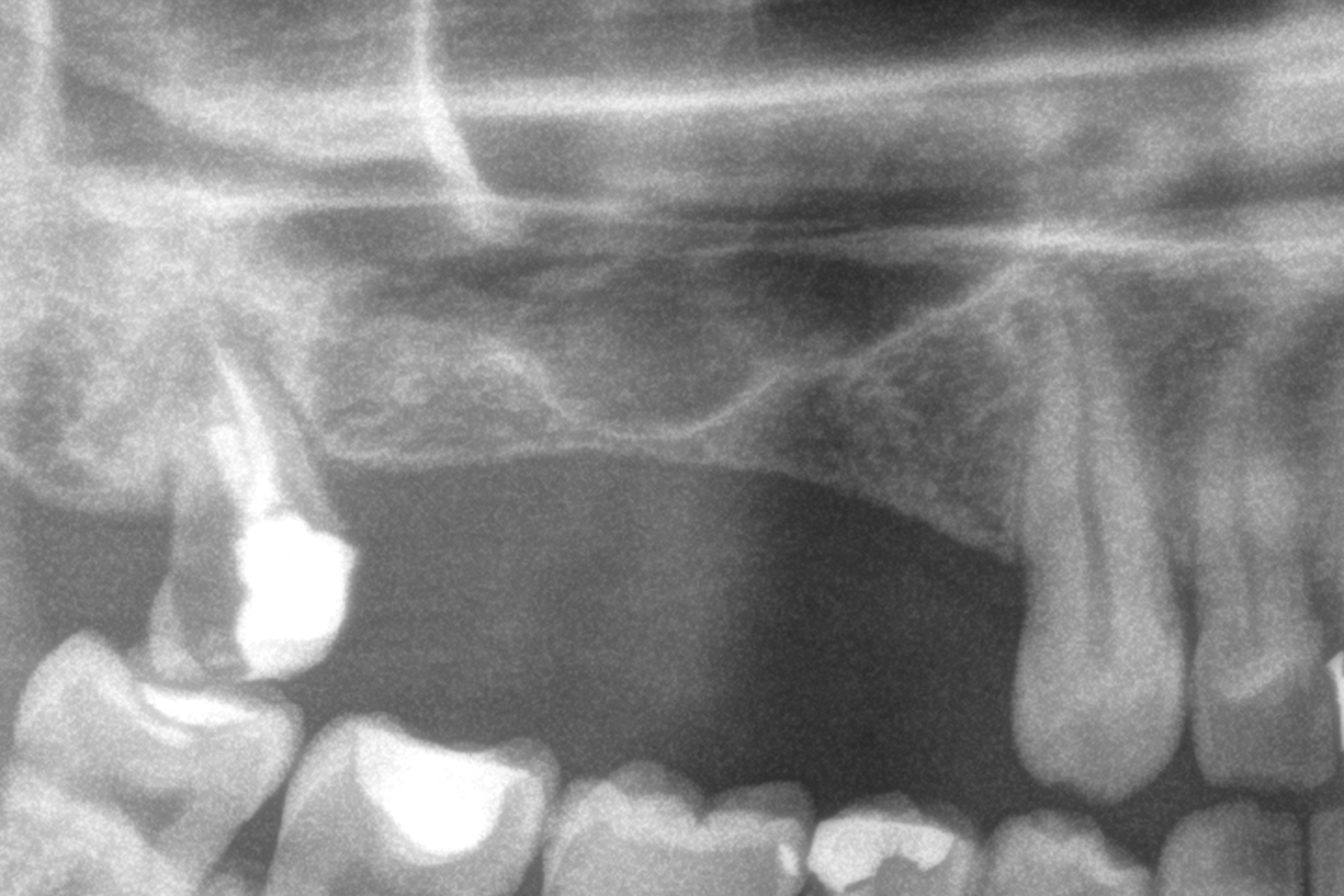 Carico immedaito impianti ultra-corti