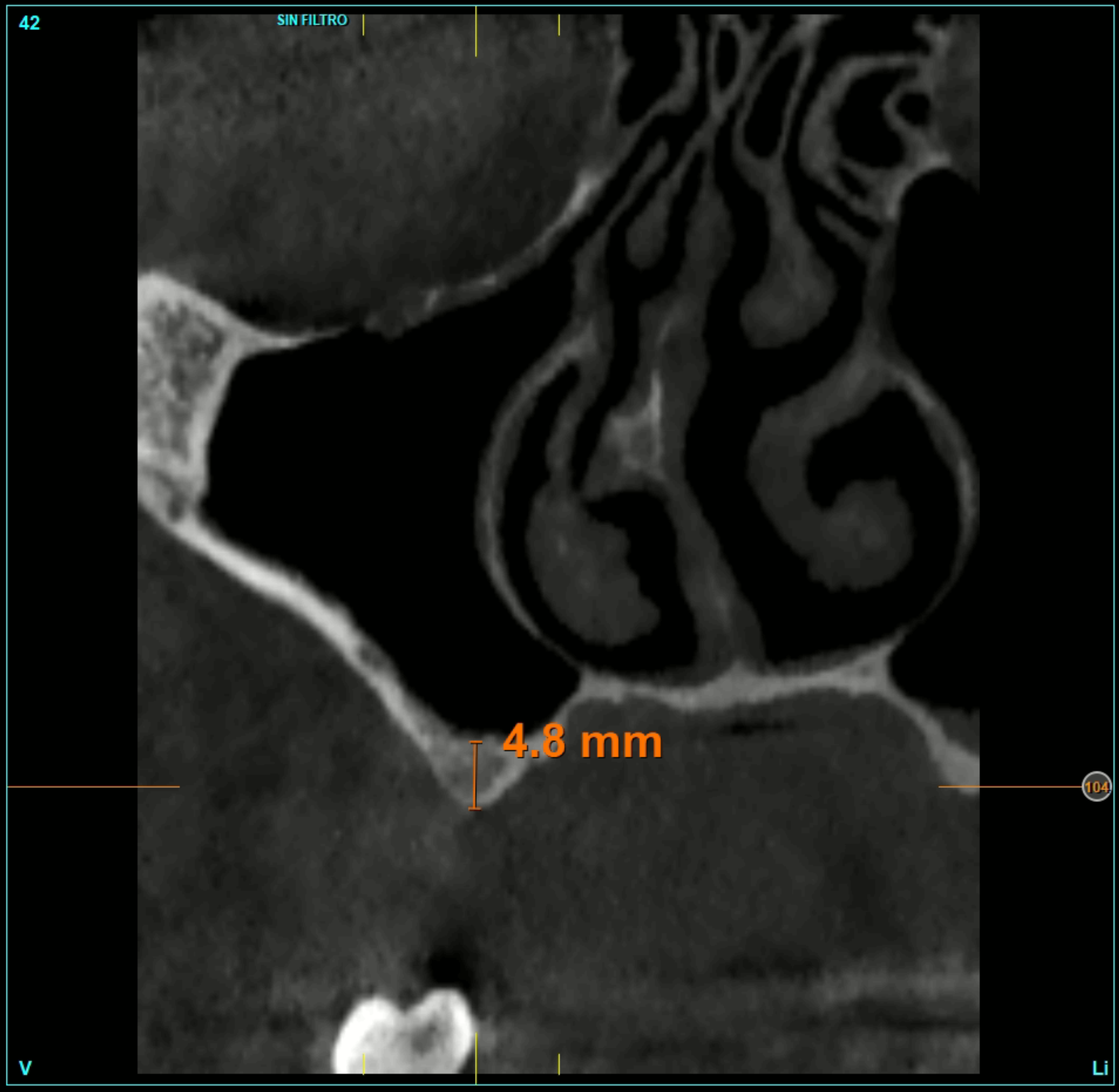 Carico immediato impianti ultra-corti
