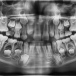 Eruzione ectopica del primo molare permanente: l’importanza della diagnosi precoce Eruzione ectopica primo molare
