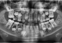 Eruzione ectopica del primo molare permanente: l’importanza della diagnosi precoce Eruzione ectopica primo molare