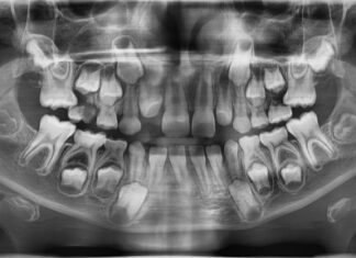 Eruzione ectopica del primo molare permanente: l’importanza della diagnosi precoce. Eruzione ectopica primo molare