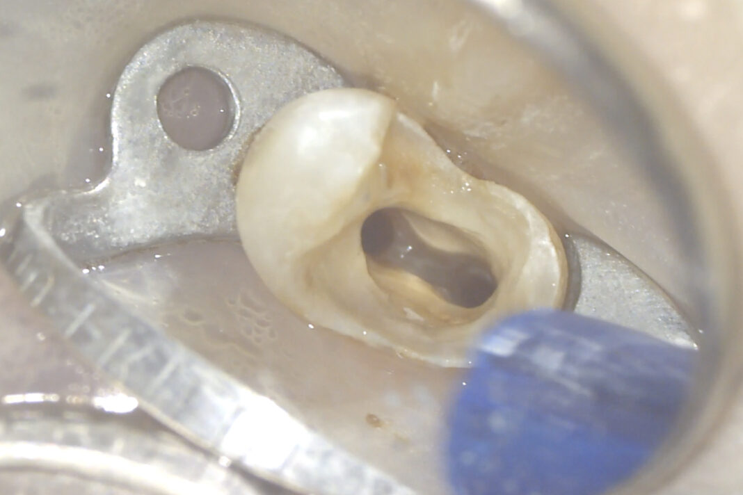 Ritrattamento canalare