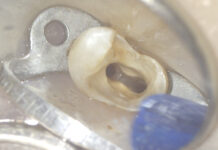 Ritrattamento di un elemento 14 con ritenzione endocanalare metallica Ritrattamento canalare