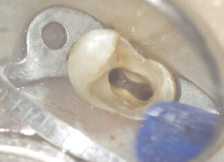 Ritrattamento di un elemento 14 con ritenzione endocanalare metallica Ritrattamento canalare