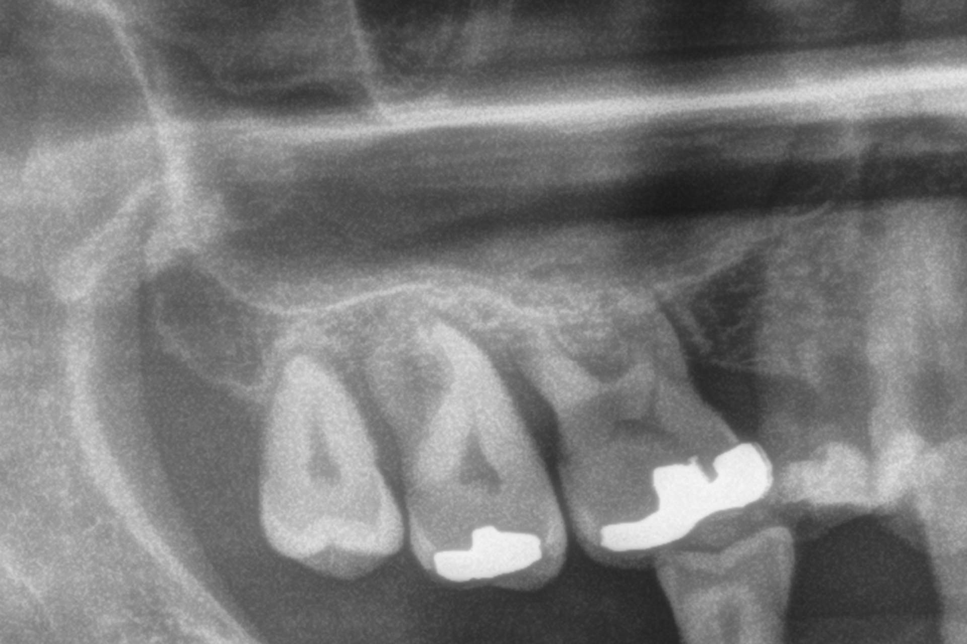 Carico immediato impianti ultra-corti