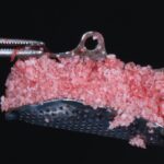 Rigenerazione ossea guidata con mesh in titanio customizzata mesh in titanio