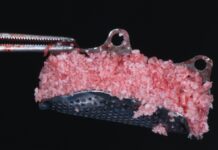Rigenerazione ossea guidata con mesh in titanio customizzata mesh in titanio