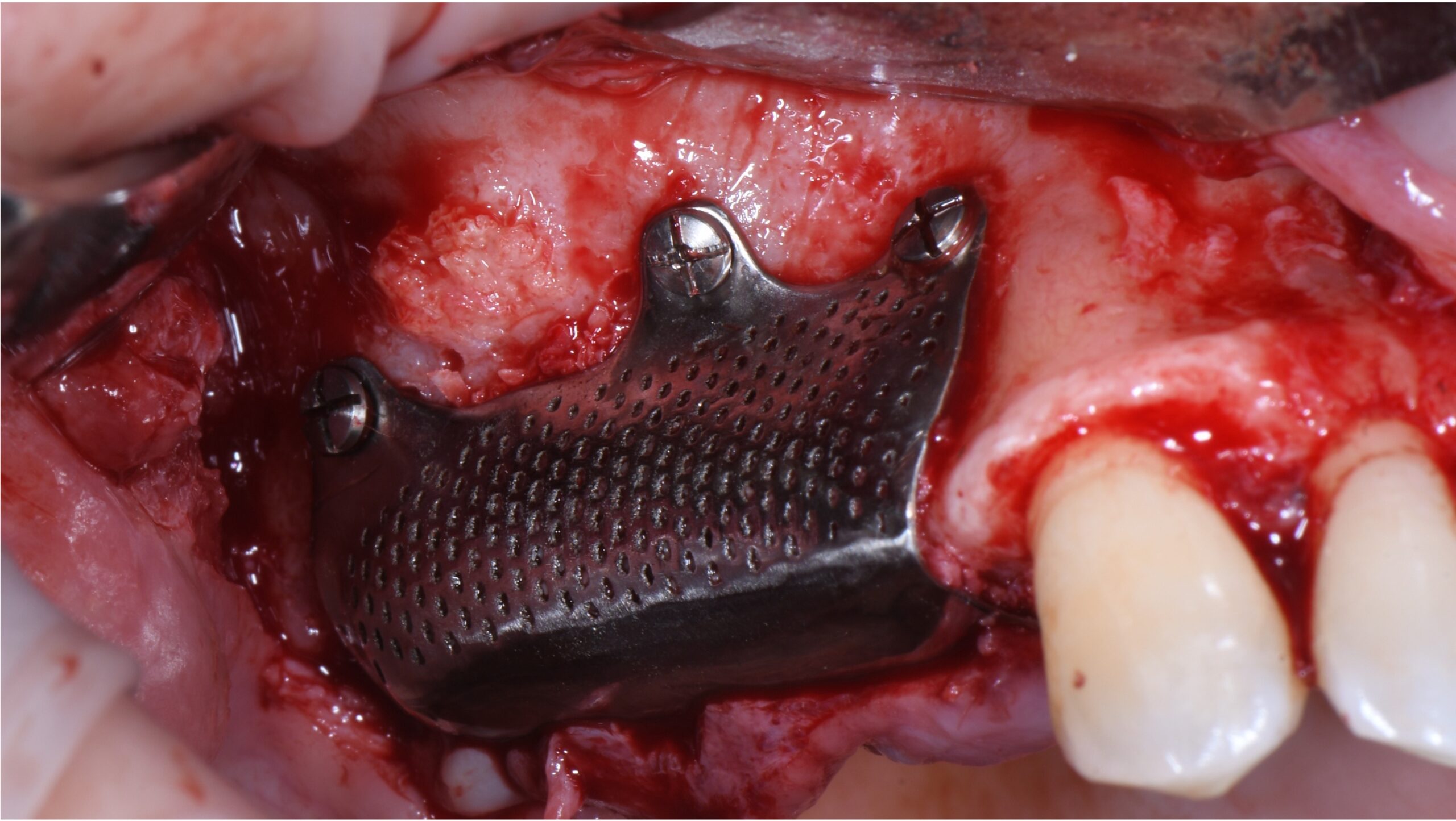 mesh in titanio 