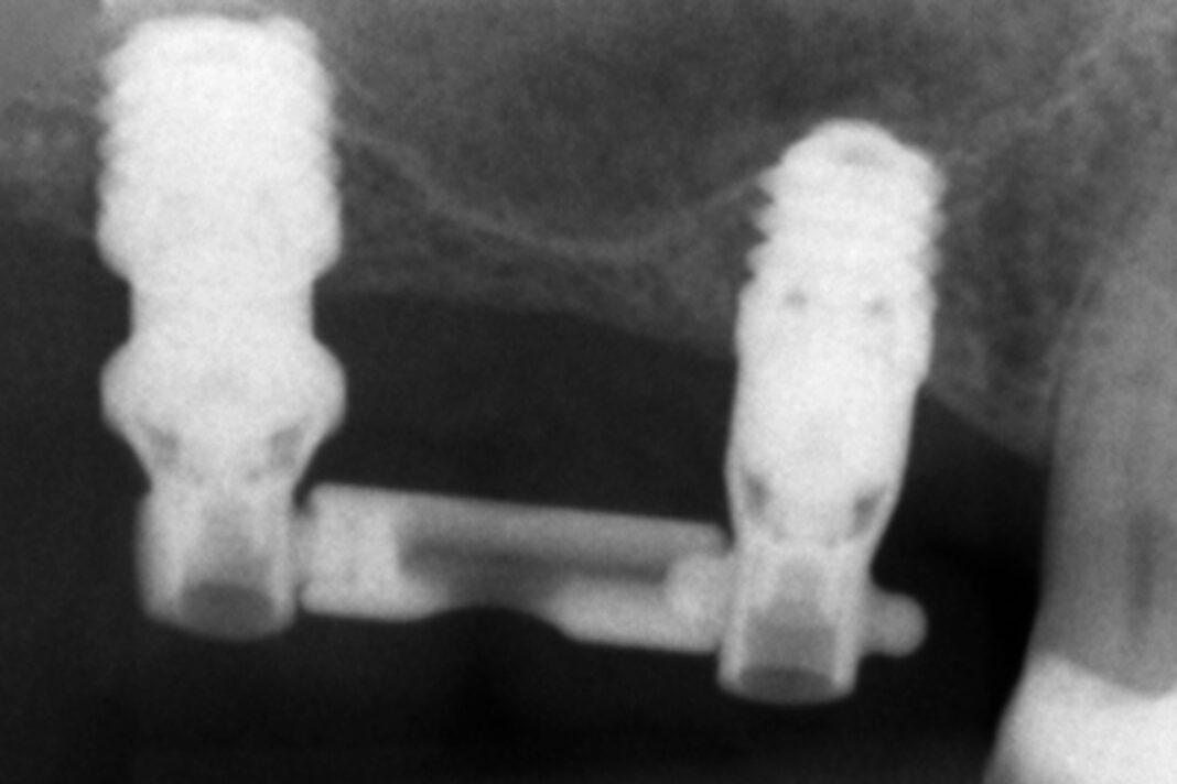 Carico immediato impianti ultra-corti