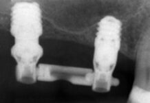 Carico immediato su impianti ultra-corti ferulizzati in riabilitazioni multiple: studio retrospettivo Carico immediato impianti ultra-corti