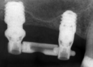 Carico immediato su impianti ultra-corti ferulizzati in riabilitazioni multiple: studio retrospettivo Carico immediato impianti ultra-corti