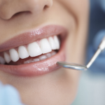 Embrasure interprossimali, come trattarle al meglio Embrasure interprossimali