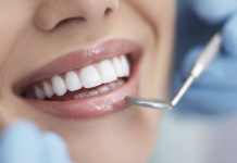 Embrasure interprossimali, come trattarle al meglio Embrasure interprossimali