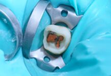 Canali radicolari: ritrattamento selettivo e sicuro Canali radicolari