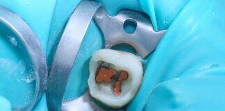 Canali radicolari: ritrattamento selettivo e sicuro Canali radicolari