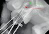 Considerazioni anatomiche e cliniche del secondo canale mesio-vestibolare (MV2) nei molari superiori secondo canale mesio-vestibolare MV2