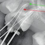 Considerazioni anatomiche e cliniche del secondo canale mesio-vestibolare (MV2) nei molari superiori secondo canale mesio-vestibolare MV2