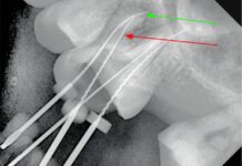 Considerazioni anatomiche e cliniche del secondo canale mesio-vestibolare (MV2) nei molari superiori secondo canale mesio-vestibolare MV2