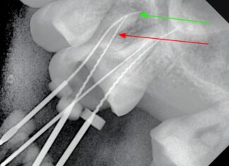 Considerazioni anatomiche e cliniche del secondo canale mesio-vestibolare (MV2) nei molari superiori secondo canale mesio-vestibolare MV2