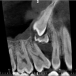 Gestione chirurgica di premolare superiore incluso in posizione ectopica a elevata profondità premolare superiore incluso