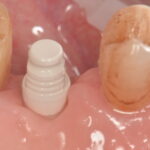 L’utilizzo delle cappette in PEEK nella gestione dei tessuti molli peri-implantari cappette in PEEK
