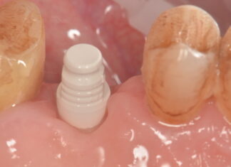 L’utilizzo delle cappette in PEEK nella gestione dei tessuti molli peri-implantari cappette in PEEK