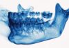 Osteoporosi e odontoiatria, verso uno screening opportunistico con la CBCT osteoporosi